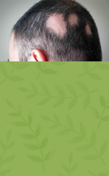 Alopecia Treatment Ayurveda Kolkata