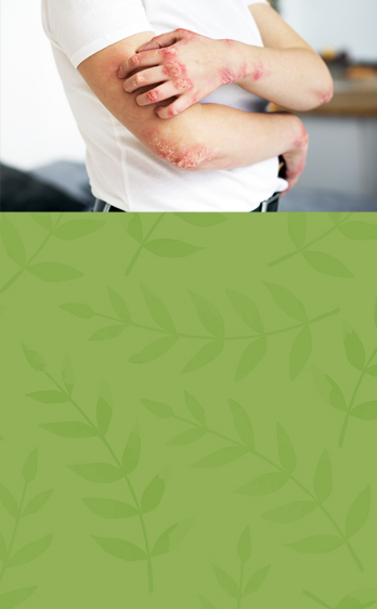 psoriasis treatment kolkata Ayurveda